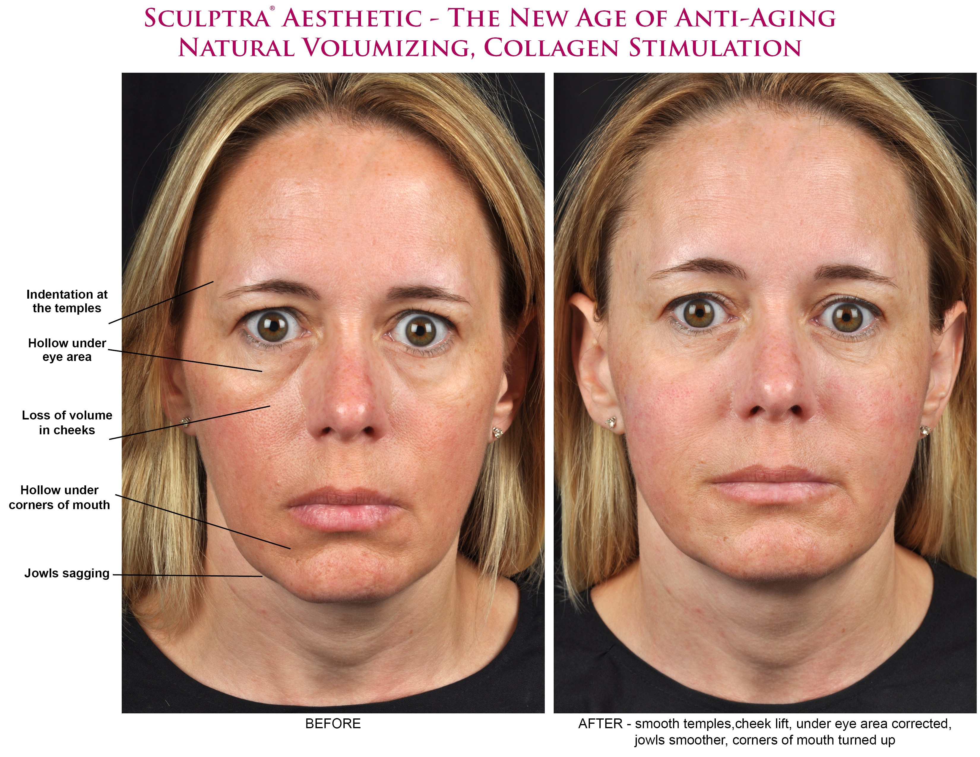 sculptra before and after face Fox Valley Plastic Surgery S.C