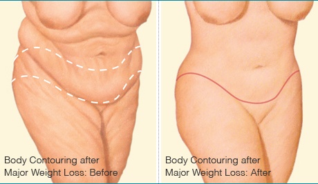 Panniculectomy vs Abdominoplasty: Body Contouring Options Compared, Waukesha, WI