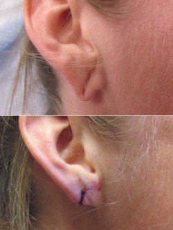 The Right Approach to Split Ear Lobe Repair