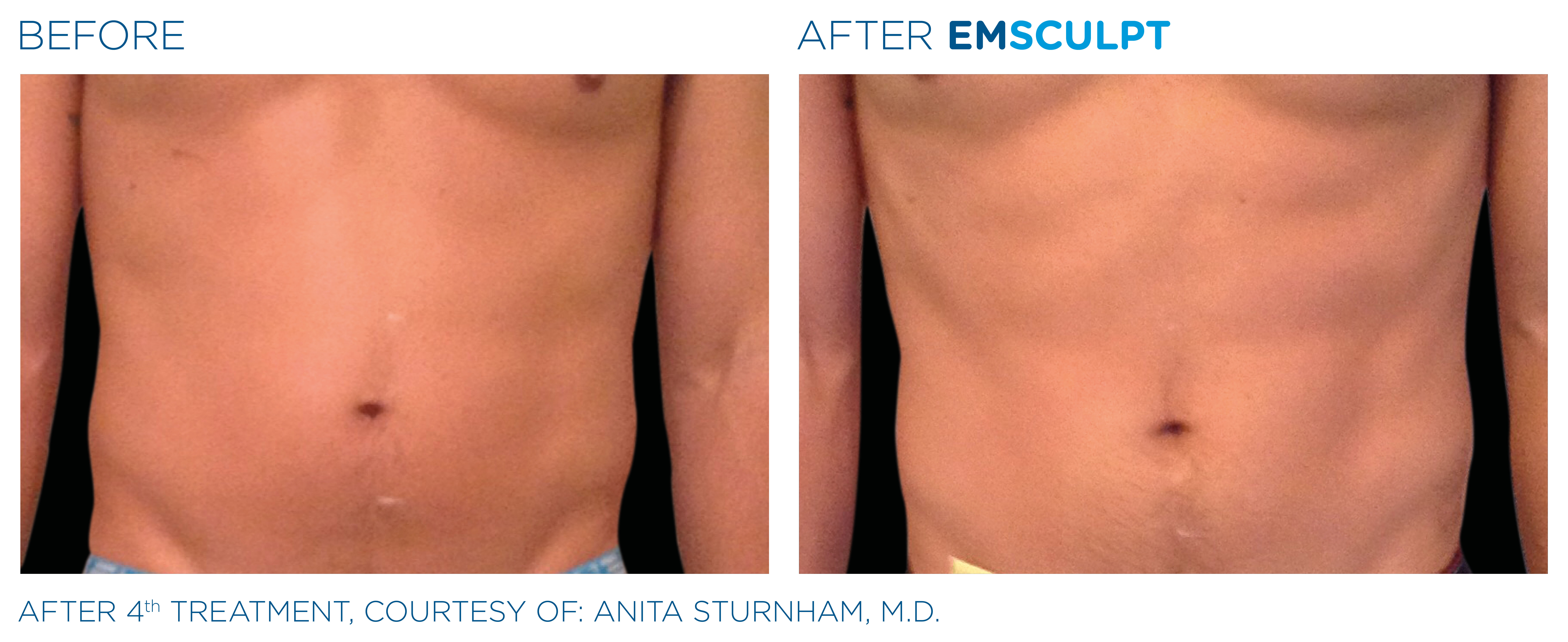 What Is EMSCULPT? - Does It Work? - Cost? - UCRYO Has It!
