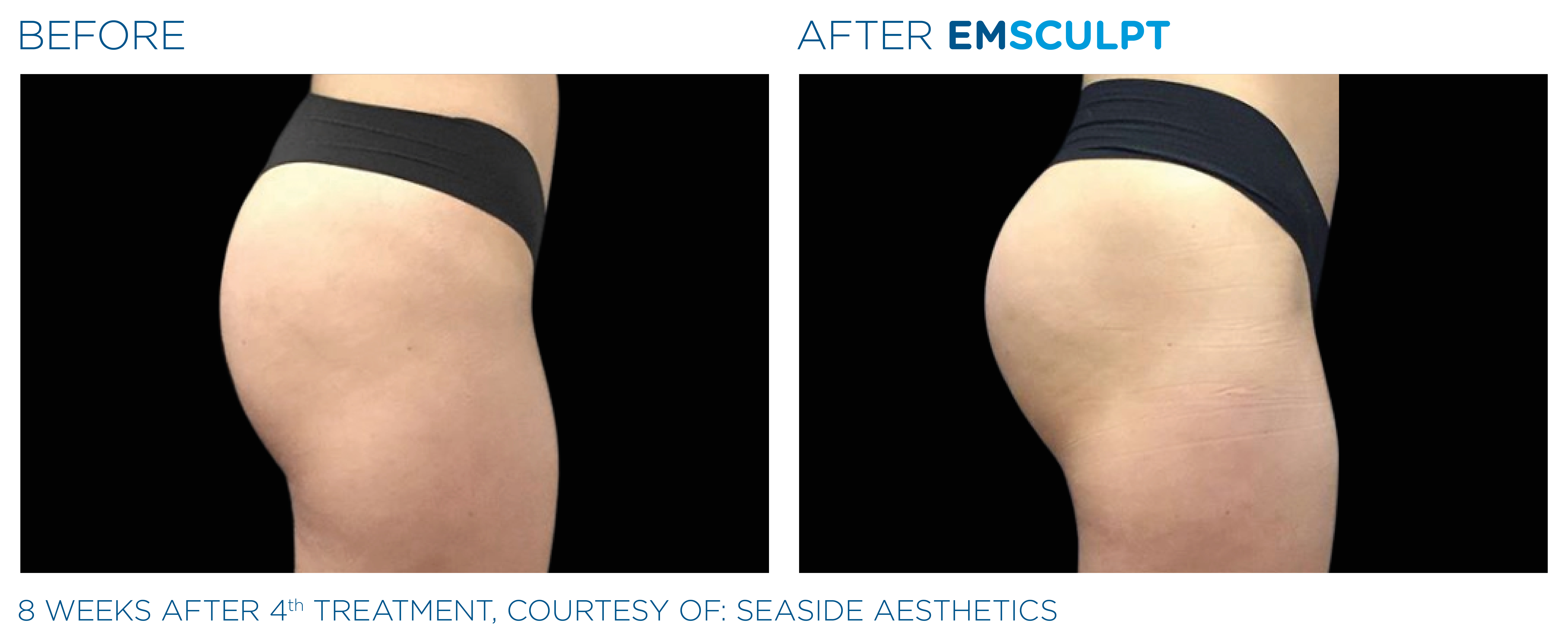 What Is EMSculpt? What to Know About the Body-Contouring Treatment