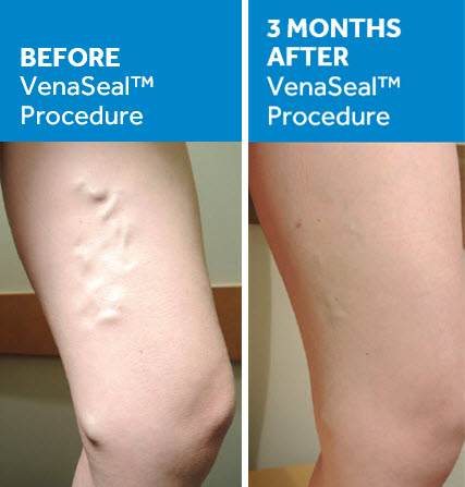 The Vein Center | VenaSeal for Varicose Veins