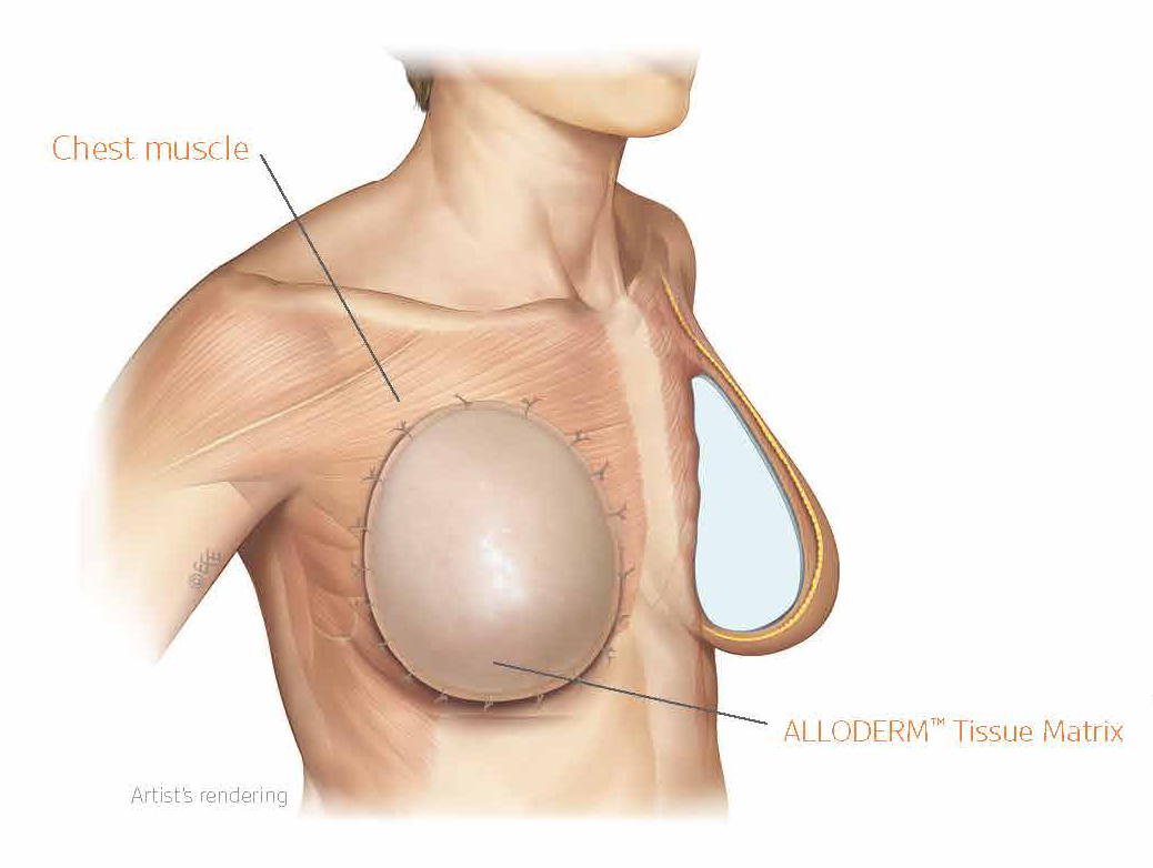 Pre-Pectoral Conversion of Implants in Breast Reconstruction