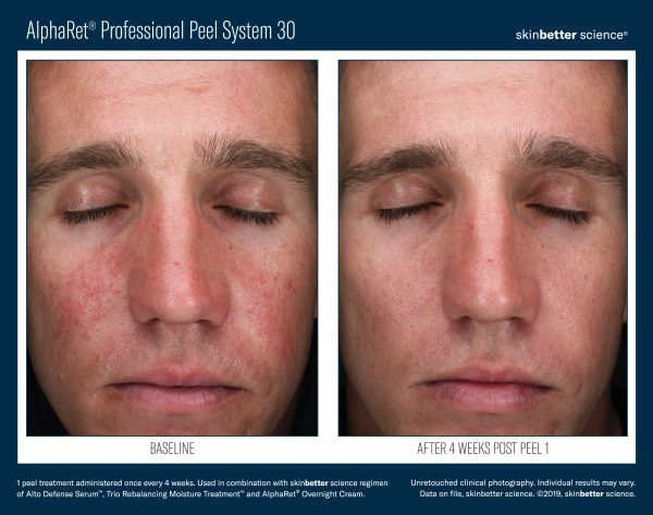 Acne Facial Before and After